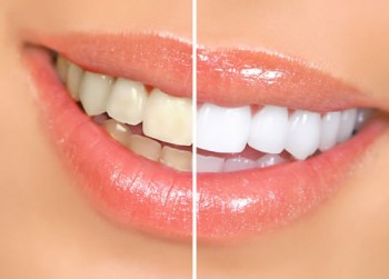 whitening1-e1417709996500